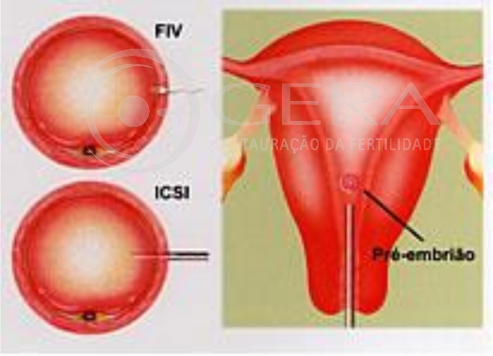 fiv-fertilizacao-in-vitro-gera-campogrande-clinica-de-fertilizacao