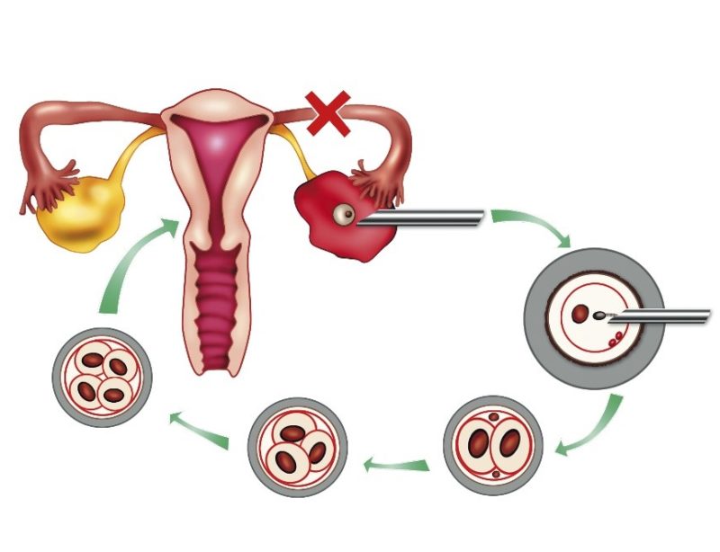 Arquivos inseminação artificial - Gera Clínica de Fertilização em Campo