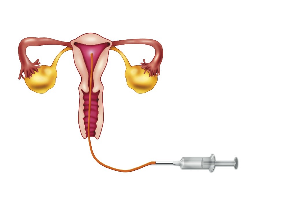 inseminacao-intrauterina-gera-clinica-fertilidade-campo-grande